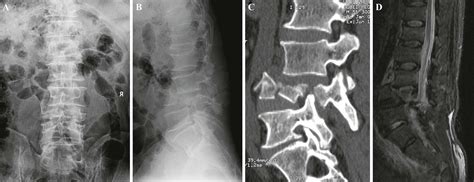 Traumatic burst fracture and dislocation of the lumbar spine with an intact neurologic function ...