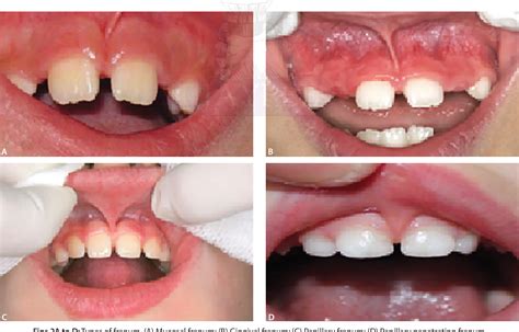 Figure 1 from Studying Maxillary Labial Frenulum Types and Their Effect ...