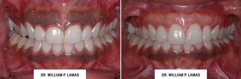 Dark Gum Depigmentation Before & After Photos - Dr. William Lamas