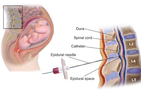 Painless Delivery ( Epidural injection ) - Doctor Zara