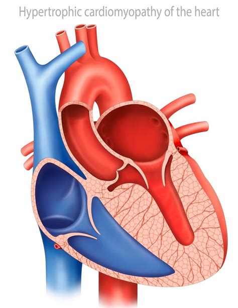HYPERTROPHIC CARDIOMYOPATHY: Condition in which the muscle of the walls of heart chambers become ...
