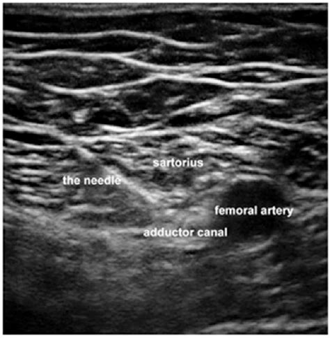 Adductor Canal Nerve Block Ultrasound