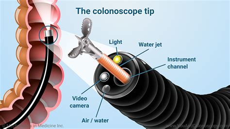 Slide Show - What happens during and after a colonoscopy?