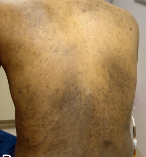 hyperpigmentation causes - pictures, photos