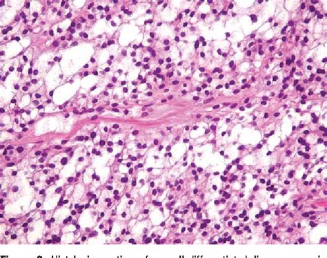 Figure 2 from Use of Oil Red O stain in the cytologic diagnosis of canine liposarcoma ...