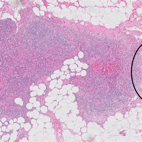 Lymph node tissue with CD 56 positive Thyroid inclusions | Download ...