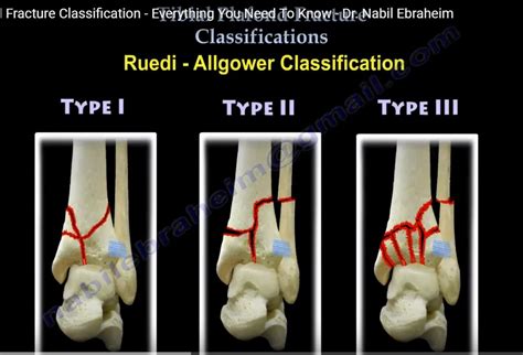 Tibial Plafond fracture Classification — OrthopaedicPrinciples.com