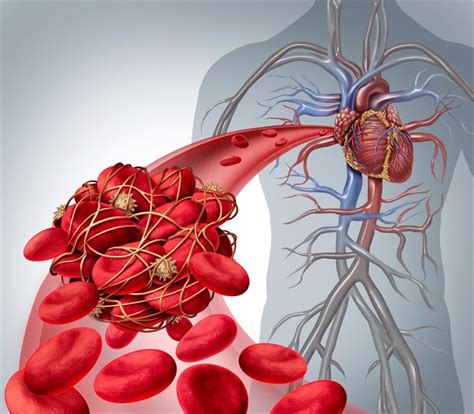 What risk factors contribute to blood clots?