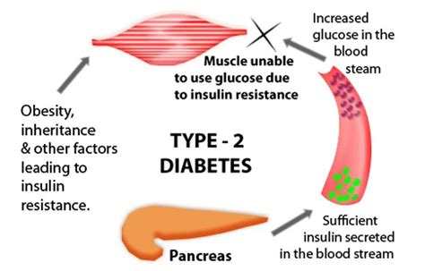 Researchers Claim To Have Found A Way To Reverse Type II Dia