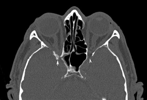 Radiodiagnosis - Imaging is Amazing-Interesting cases: Traumatic optic ...