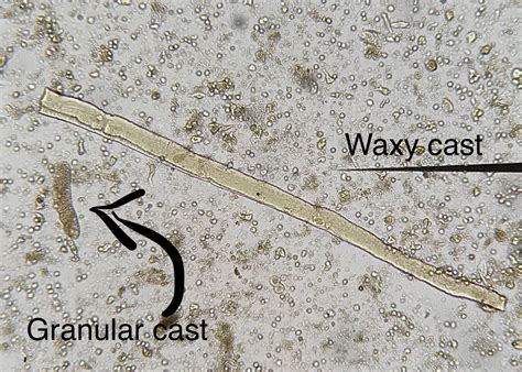 Granular Cast In Urine