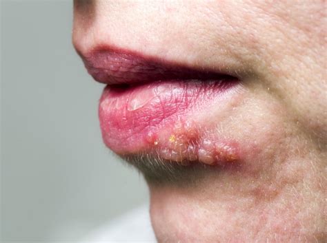 Shingles on the face: Symptoms, treatment, and causes