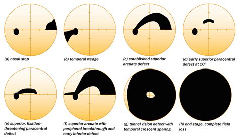 Glaucoma Vision Loss Pattern