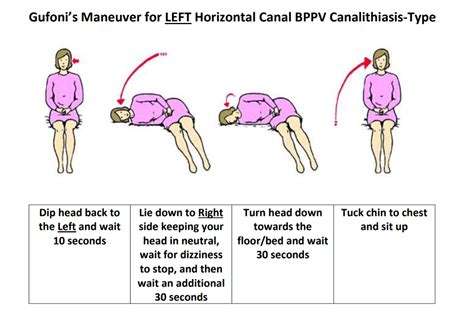 Directions for the epley maneuver for vertigo - menssem