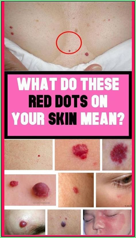 What Do The Red Moles On The Body in 2023 | Red moles, Red dots, Dots