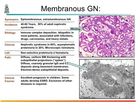 Pathology of Glomerulonephritis