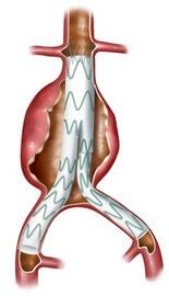 Endovascular Aneurysm Repair (EVAR) | circulationfoundation.org.uk