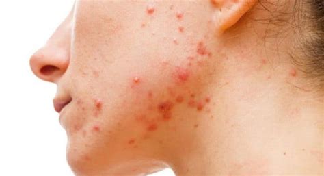 How To Get Rid Of Acne Scabs - All You Need Infos