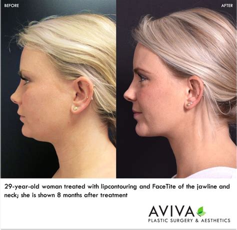 Jawline and Neck Contouring | Face tightening procedures, Skin tightening surgery, Tighten neck skin