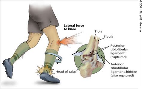 Ankle Internal Rotation