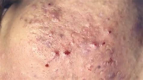 Get rid of old blackhead at home - YouTube