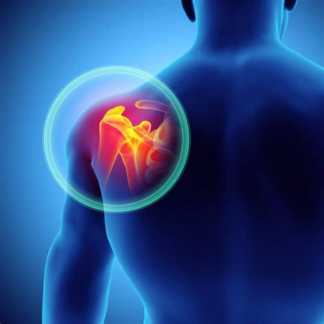 3 Ways To Treat Bone Spurs in the Shoulder - High Mountain Orthopedics