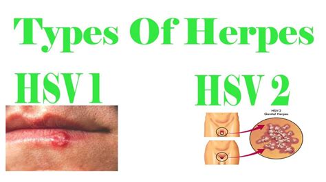 HERPES TYPES- DIFFERENT TYPES OF HERPES VIRUSES - Herpes Cure