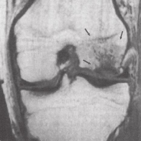 MRI scan showing a bone bruise on the lateral femoral condyle. Note the... | Download Scientific ...