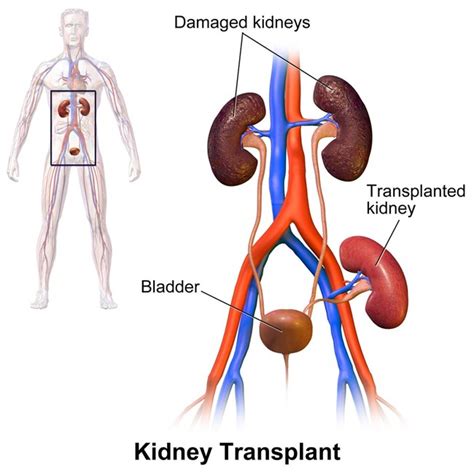 Kidney Transplant : Types, Procedure, Risk & Cost » How To Relief