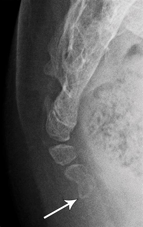 Does Lumbosacral X Ray Include Coccyx at Ruth Hernandez blog