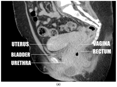 Retroflexed Uterus Mri