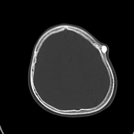 Skull vault osteoma | Radiology Reference Article | Radiopaedia.org