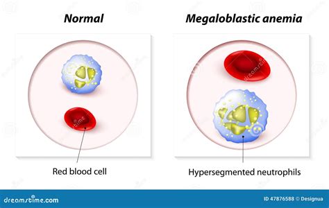 Macrocytosis Clipart And Illustrations