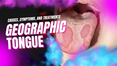 Understanding Geographic Tongue: Causes, Symptoms, and Treatments - Walkin Lab