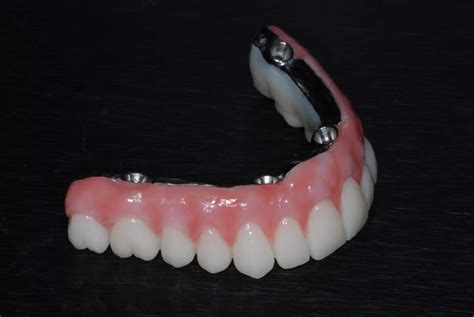 All on 4 Denture Implant Prosthesis Material | North Texas Dental Surgery