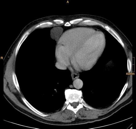 Pericardial cyst | Radiology Reference Article | Radiopaedia.org