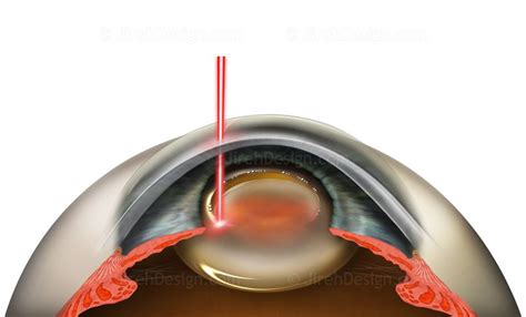 Femtosecond laser capsulorhexis #SUCA0071 - Stock eye images