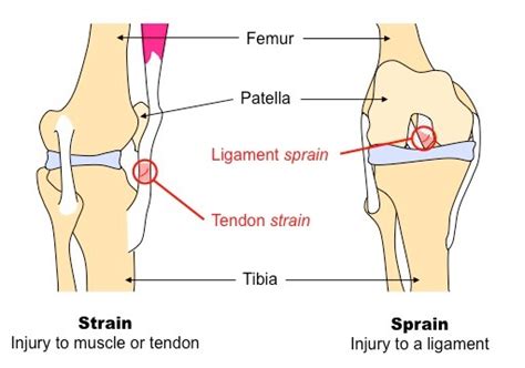 Georgia Clinic of Chiropractic - Augusta, GA - Treatment for sprain and ...