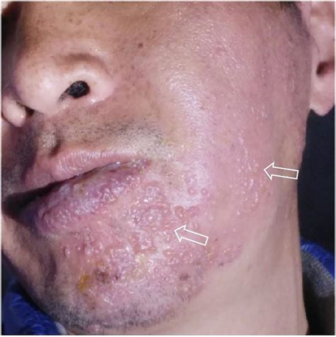 Frontiers | Ramsay Hunt syndrome and mandibular alveolar bone necrosis following herpes zoster ...