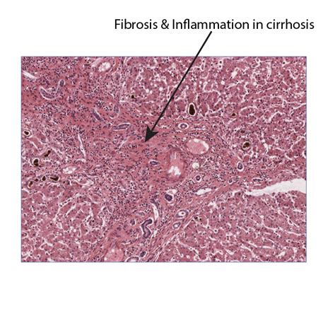 Pathology Glossary: Liver Cirrhosis | Draw It to Know It