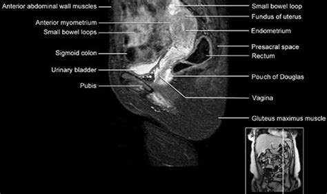 Uterus Anatomy Mri