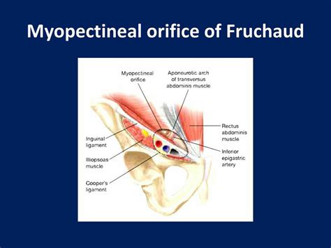 Myopectineal Orifice