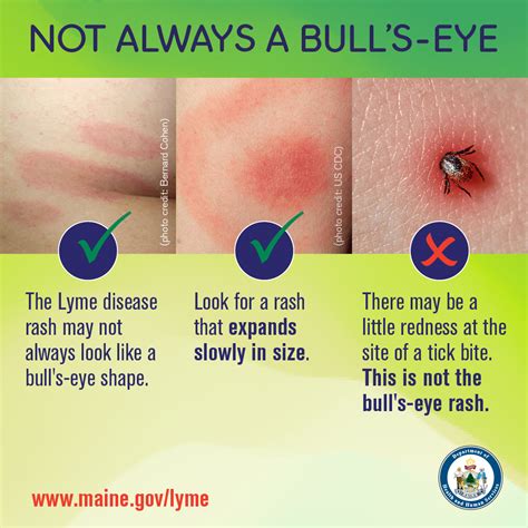 Maine CDC - The Lyme disease bull’s-eye rash may look...