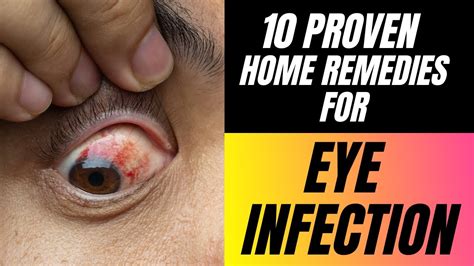 10 Proven Home Remedies for Eye Infection - YouTube