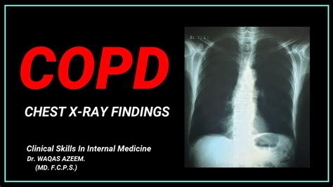 COPD (Chest X-ray findings) - YouTube