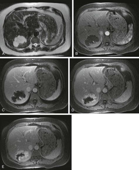 Benign Tumors of the Liver | Radiology Key