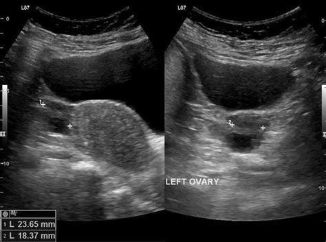 Dermoid Cyst || Ultrasound || Case 164, 57% OFF