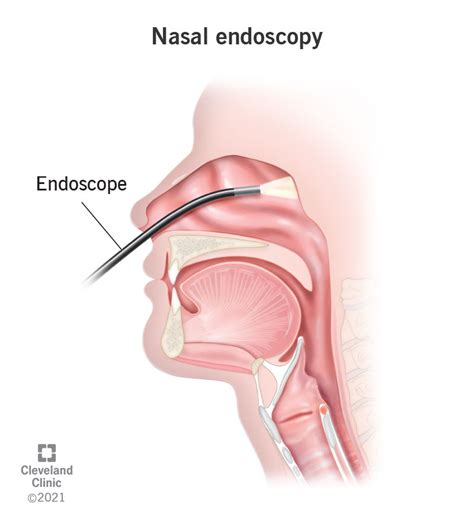 Nasal Endoscopy: Procedure & What It Is