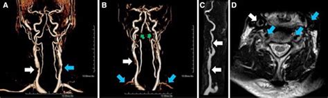 MRI and MRA visualization of carotid artery stenosis in a 71-year-old... | Download Scientific ...