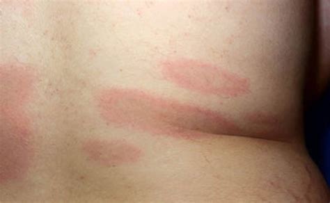 Lyme Disease - Rash, Causes, Symptoms, Diagnosis and Treatment